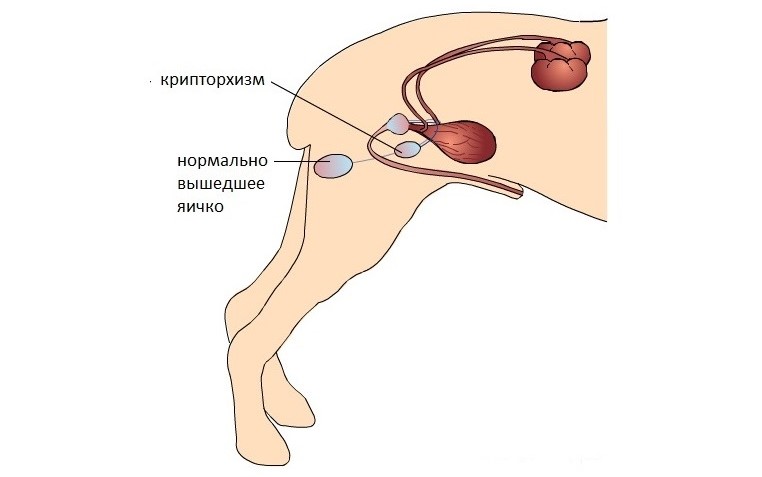 Крипторхизм