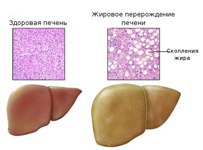 рис 1 липидоз печени.jpg рис 1 липидоз печени.jpg